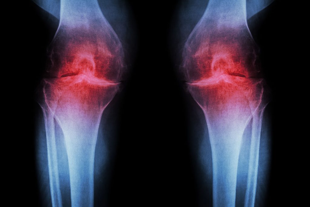 Osteoartrita sau poliartrita? Ce le diferentiaza