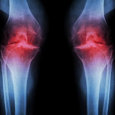 Osteoartrita sau poliartrita? Ce le diferentiaza